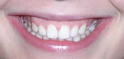 Glendale, AZ Braces Othodontics After
