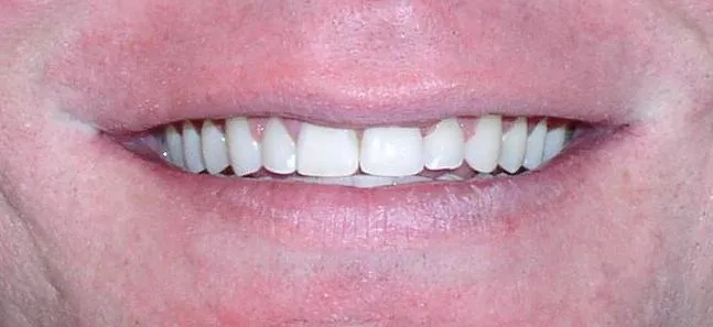 Misaligned Teeth Orthodontic Dentist Braces After