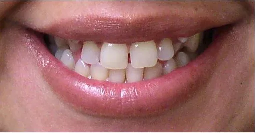 Orthodontic Disorder Cosmetic Dentist Before