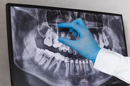 Affordable Root Canal Treatment Near Peoria