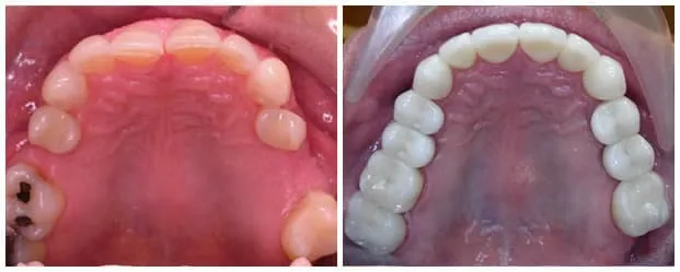 Dental implant smile gallery example