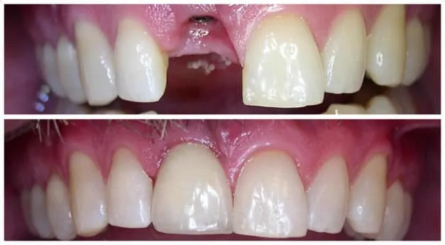 Dental implant smile gallery before and after