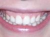 Glendale, AZ Braces Othodontics After