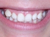 Glendale AZ Braces Othodontics Before