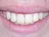 Glendale Overbite Orthodontics After