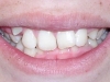 Glendale Overbite Orthodontics Before