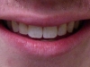 Misaligned Teeth Orthodontic Braces North Phoenix After