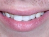 Misaligned Teeth Orthodontic Braces North Phoenix Before