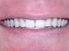 Misaligned Teeth Orthodontic Dentist Braces After