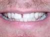 Misaligned Teeth Orthodontic Dentist Braces Before