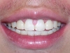 North Phoenix Overbite Correction Orthodontics After
