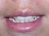 North Phoenix Overbite Correction Orthodontics Before