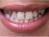 Orthodontic Disorder Cosmetic Dentist Before