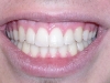 Peoria Arizona Cosmetic Dentist Orthodontics After