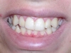 Peoria Arizona Cosmetic Dentist Orthodontics Before
