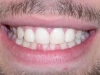 Spacer Expansion Tooth Dental After