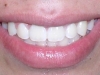 Underbite Orthodontic Procedure Peoria AZ After