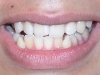 Underbite Orthodontic Procedure Peoria AZ Before