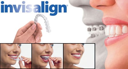 Aesthetic Dentistry of Arrowhead offers Invisalign, which has many benefits, as one of their services