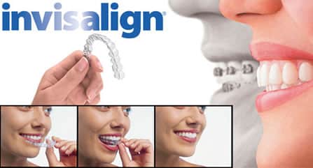 Invisalign in Glendale AZ