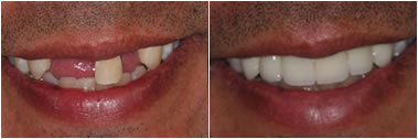 Glendale Cosmetic Dental Makeover By Aesthetic Dentistry of Arrowhead