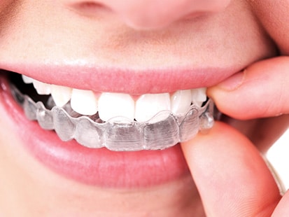 Invisible Invisalign Braces Glendale with Aesthetic Dentistry of Arrowhead