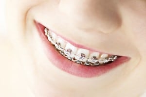 Glendale AZ Orthodontic Options Available With Aesthetic Dentistry of Arrowhead