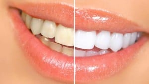 teeth whitening