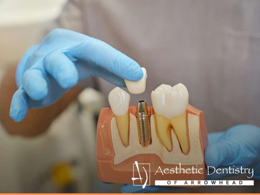 Dentist holding a model of teeth and showing how Dental Implants are placed in the jawbone.