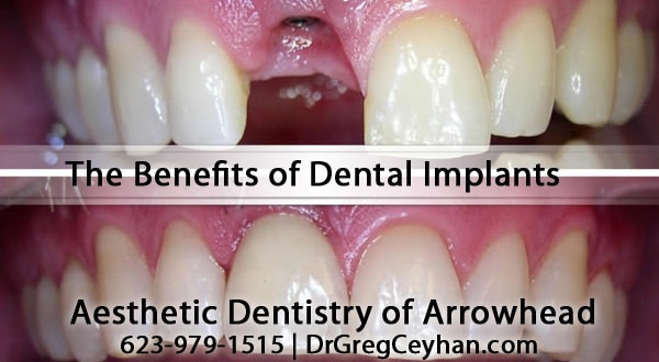 The Benefits of Peoria Dental Implants With Dr. Greg Ceyhan