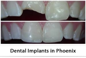 Services for Dental Bonding in Phoenix, AZ