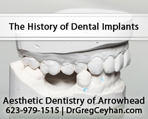 The History of Dental Implants in North Phoenix