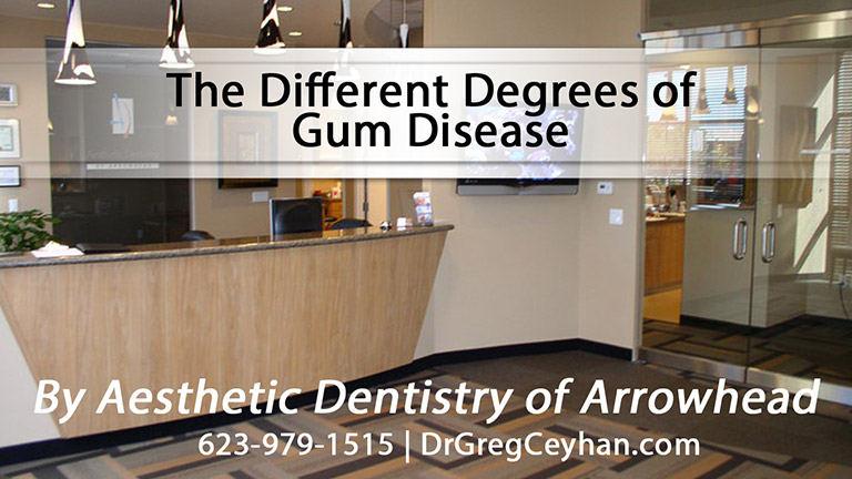 The Different Degrees of Gum Disease