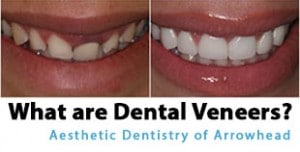 What Are Dental Veneers?