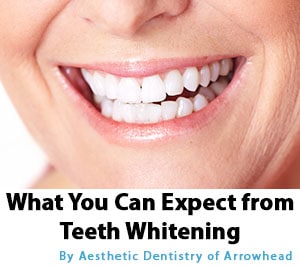 What You Can Expect From Teeth Whitening