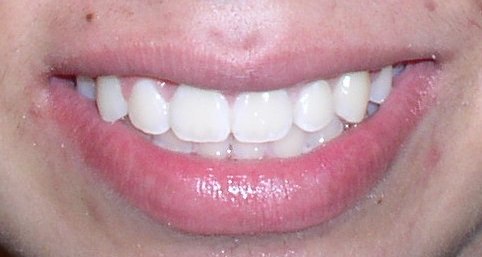 A smile that has been corrected via the orthodontic services provided by Dr. Greg Ceyhan of Arrowhead, in the northern part of the city of Glendale