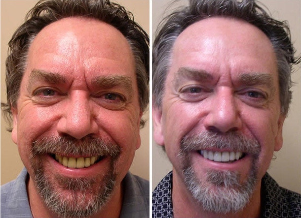 Male Patient With Teeth Whitening