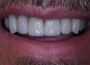 Male Patient With Teeth Whitening After