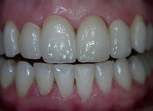 Female Patient Dental Transformation After