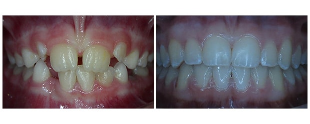 Before & After after procedure by Dr. Ceyhan from Aesthetic Dentistry of Arrowhead