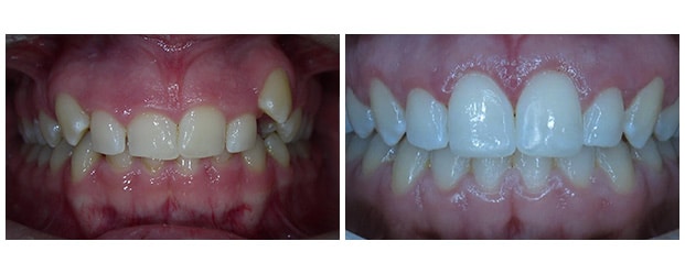 Before And After Braces And Dental Implant