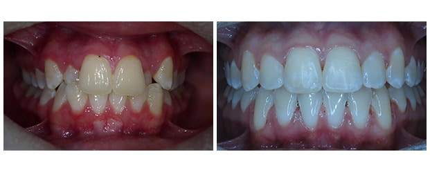 Before And After Teeth Whitening