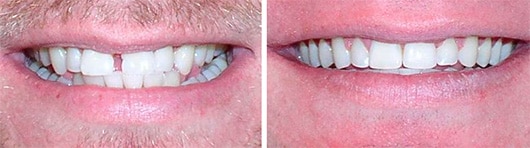 Before And After Braces Treatment In Glendale