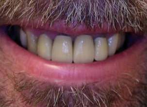 Male Patient With Teeth Whitening Before