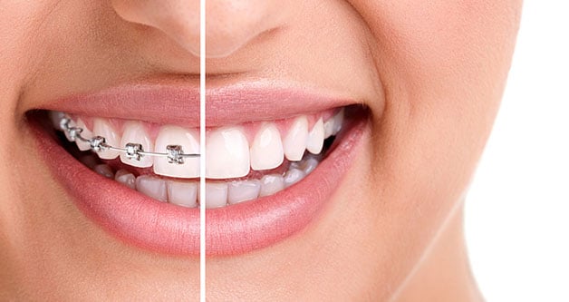 The different types of Glendale braces offered with Dr. Greg Ceyhan