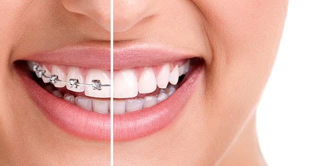 The different types of Glendale braces offered with Dr. Greg Ceyhan