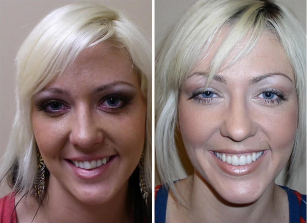 Dentist Smile Makeover by Dr. Ceyhan Glendale AZ