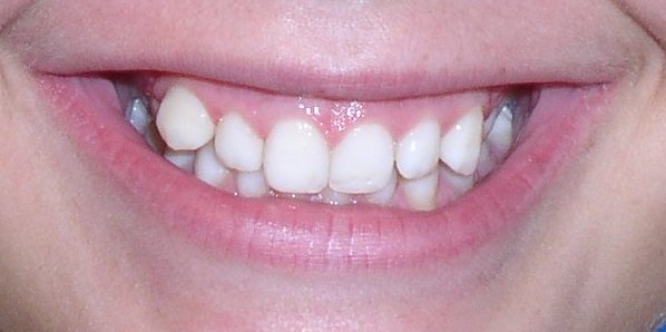 Before Orthodontic Treatment