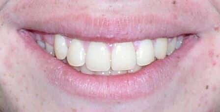 After Orthodontic Treatment