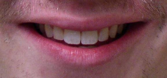 Misaligned Teeth Orthodontic Braces North Phoenix - After